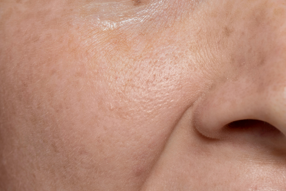Poros dilatados: dermatologista explica o que são e como tratar