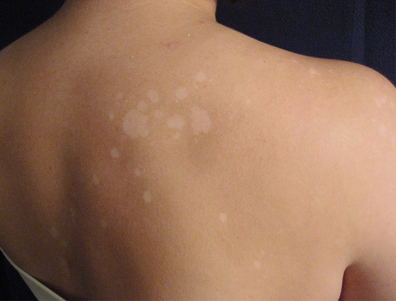 Pano branco: você sabe o que é isso?