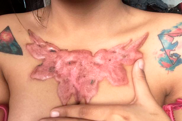 O que o erro da jovem tailandesa pode nos ensinar sobre remoção de tatuagem