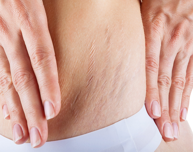 3 coisas que você não imaginou sobre as estrias