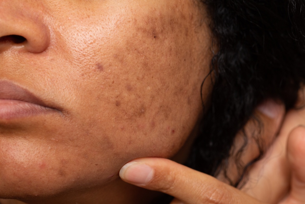 O que é melasma e como evitar o surgimento das manchas?