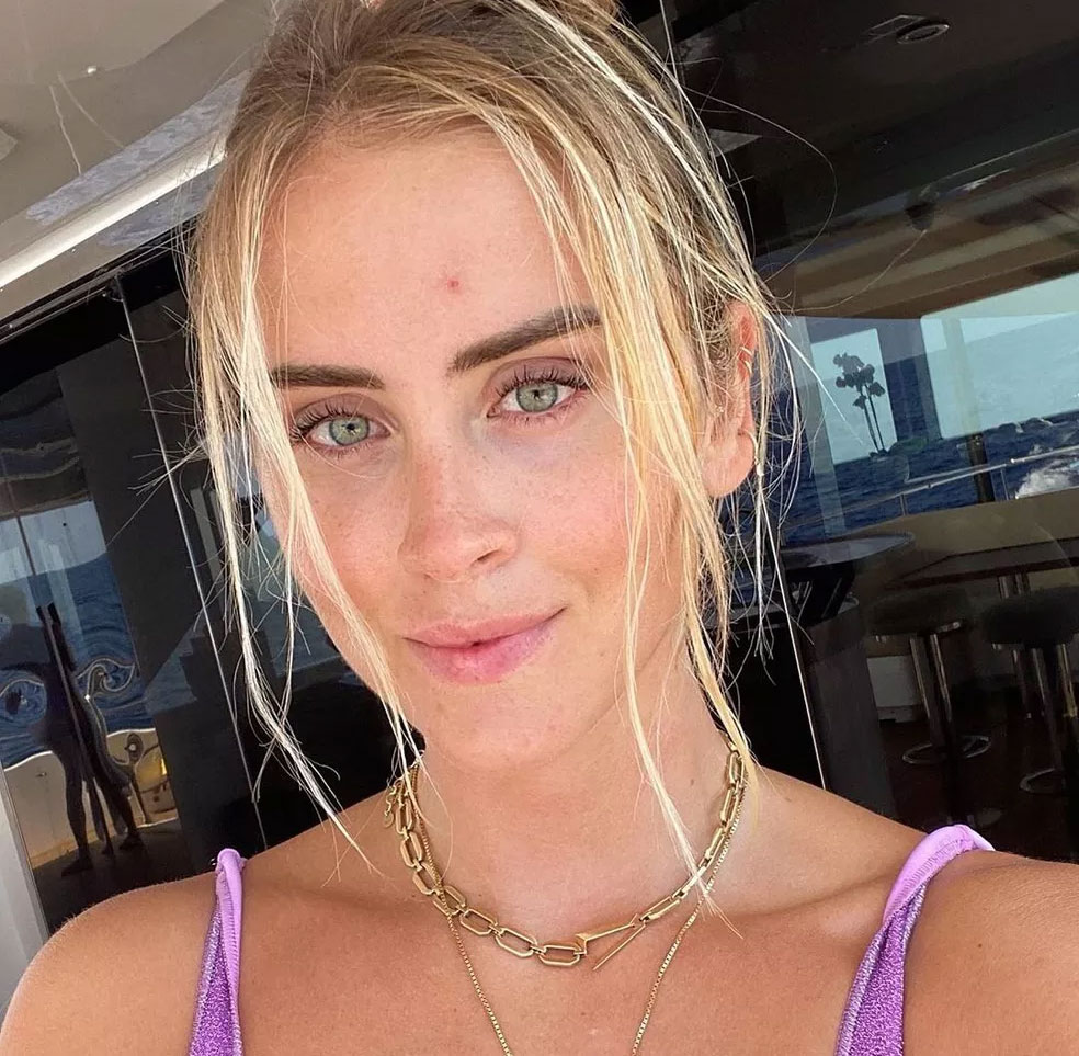 Câncer de pele: entenda a lesão rara da irmã de Chiara Ferragni