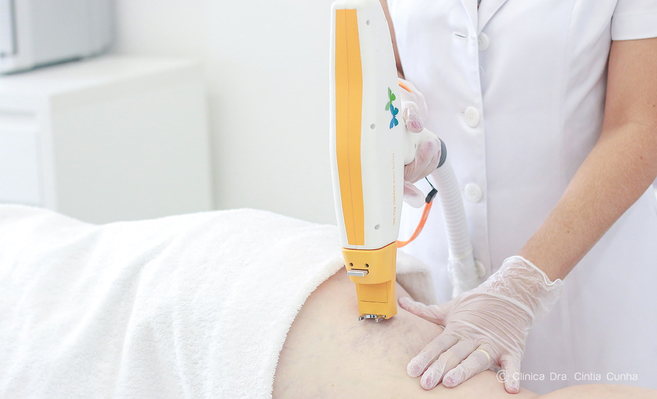 Luz pulsada ou laser Nd-Yag: qual a melhor técnica para tratamento dos vasinhos?