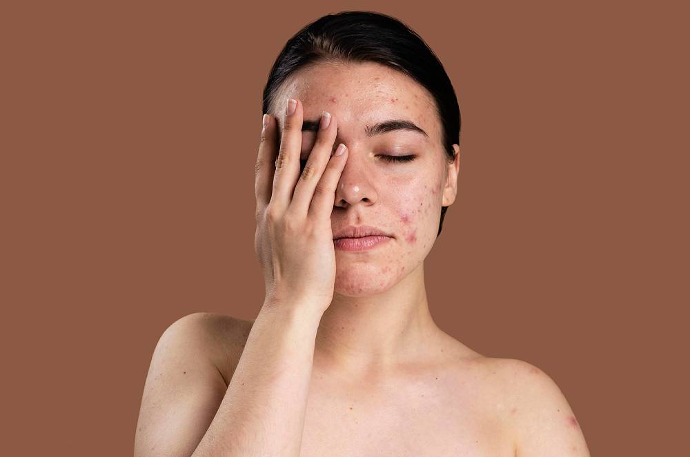 Estratégias eficazes para acne na mulher adulta