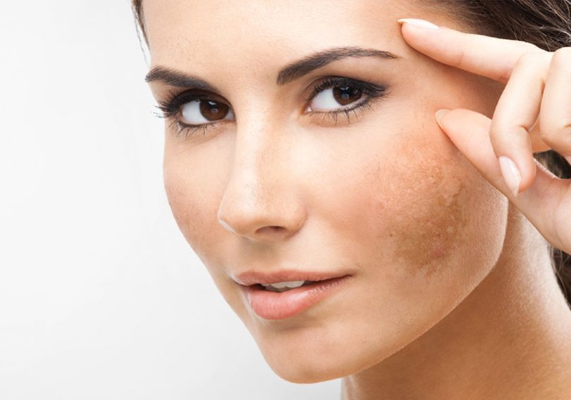 Os 3 pilares que todo tratamento de melasma precisa ter