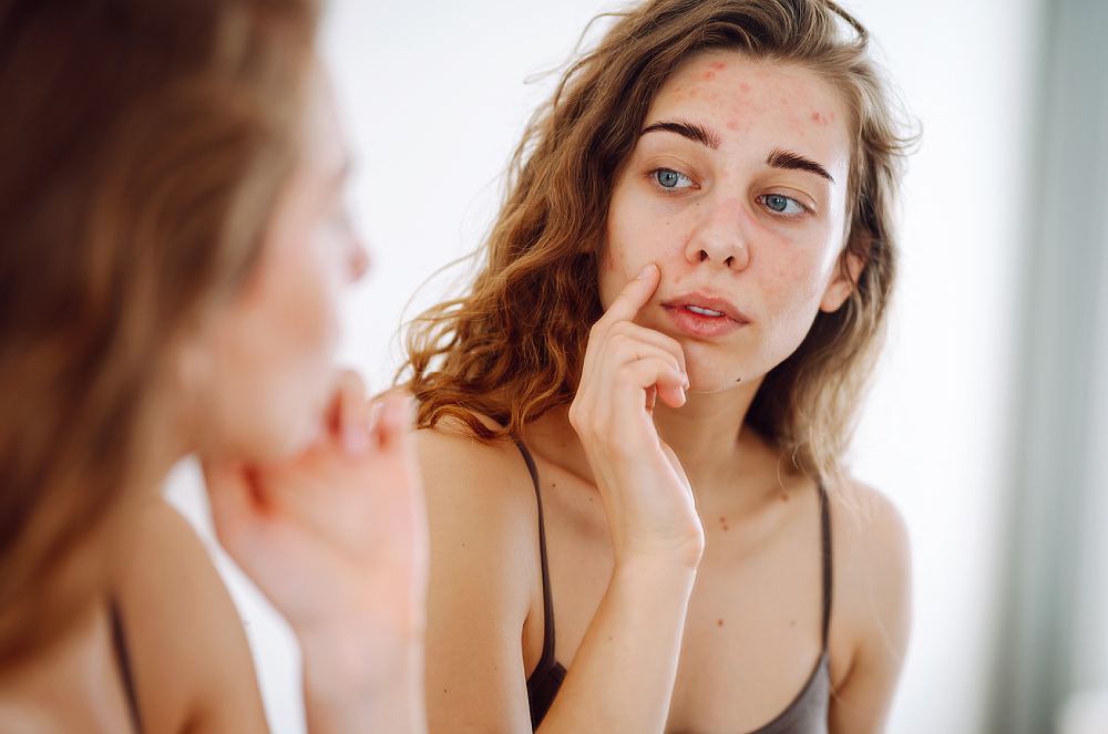 Não é só acne: o que sua pele está tentando te mostrar