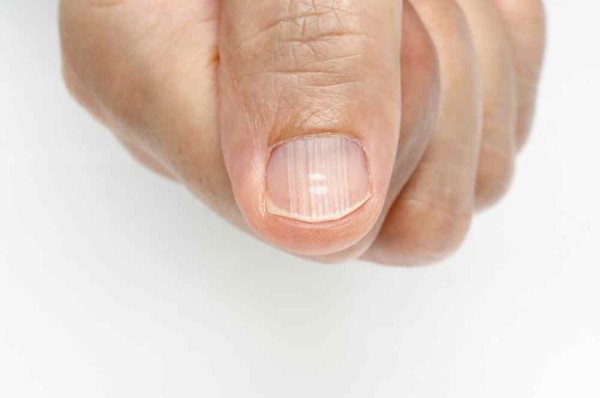 Unhas estriadas: o que pode ser e como tratá-las