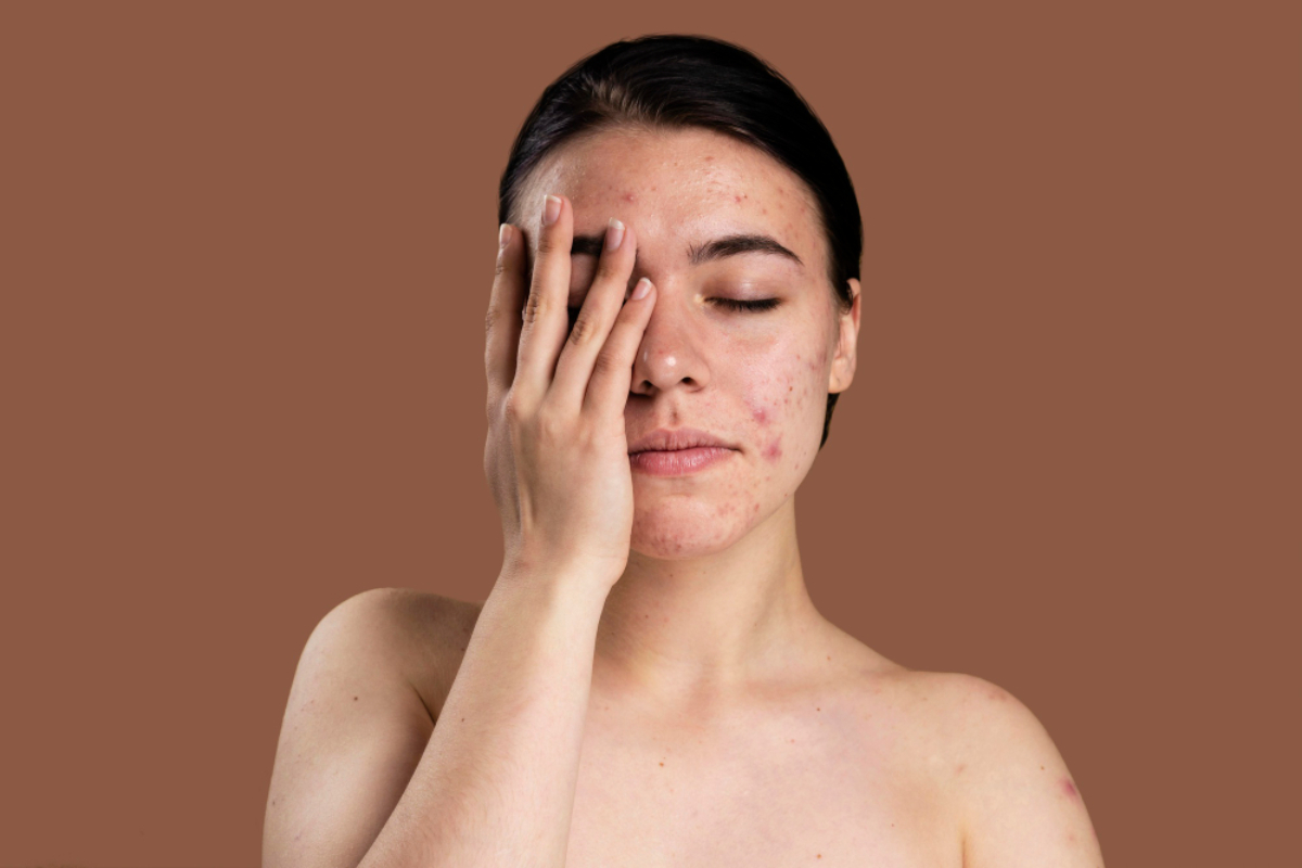 O que causa cicatriz de acne?