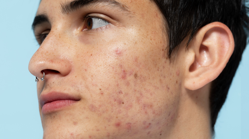 Cicatrizes de acne têm tratamento